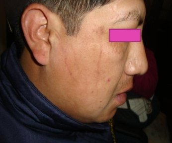 Mejilla con piel uniforme después del tratamiento de láser frío